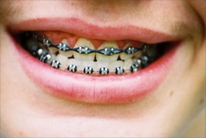 Auch die Zahnregulierung ist Teilgebiet der Zahnästhetik.